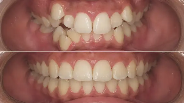 Ortodoncia y brackets